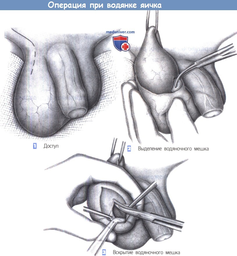 Операция при гидроцеле: какой метод выбрать 