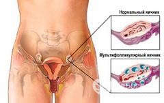 Основные признаки мультифолликулярных яичников и способы их лечения 