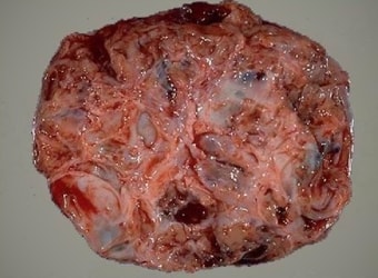 Особенности гранулезоклеточной опухоли яичников 