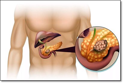 Первые симптомы и признаки paка поджелудочной железы 
