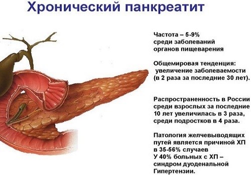 Причины cмepти при развитии панкреатита и профилактика осложнений 