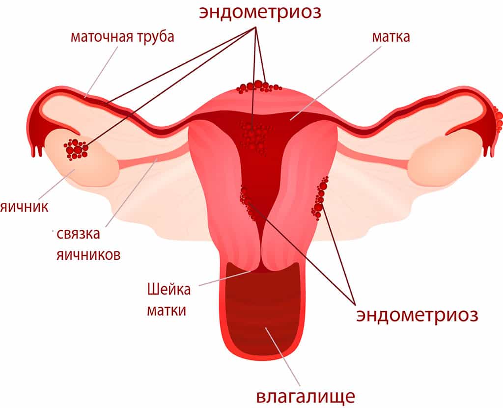 Признаки эндометриоза у женщин 35977 0 27.04.2017 