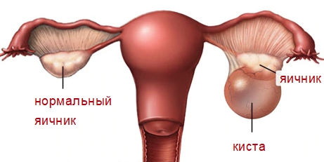 Признаки и симптомы цистаденомы правого яичника, методы лечения кистоподобной опухоли доброкачественного хаpaктера 