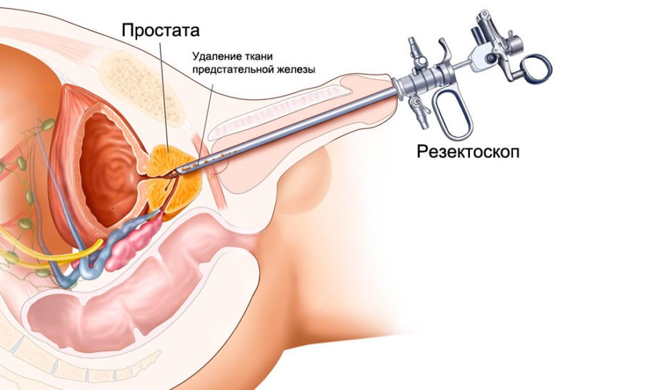 Простатэктомия: показания, виды, проведение, реабилитация 