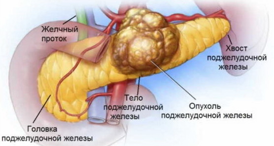 Рак поджелудочной 4 стадия 