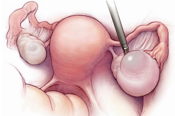 Резекция яичника: показания, способы, ход операции, осложнения, реабилитация 
