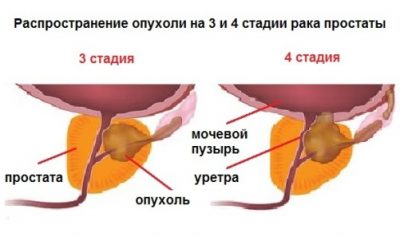 Симптомы paка предстательной железы 3 степени: прогноз 