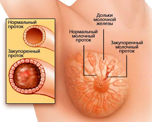 Уплотнение в молочной железе — виды, причины, особенности и лечение 