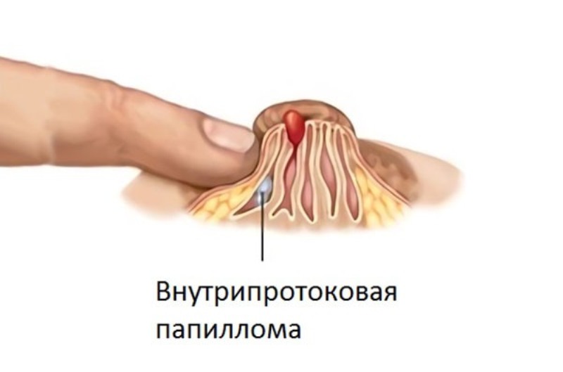 Внутрипротоковая папиллома молочной железы 