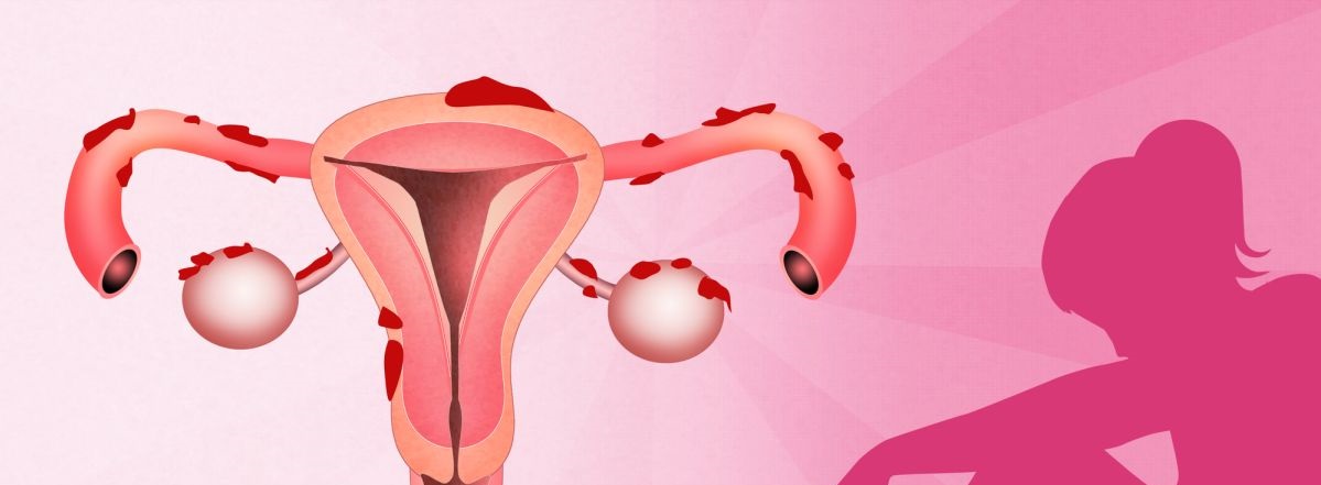 Возможна ли беременность при эндометриозе 
