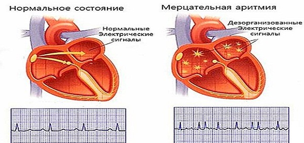 Аритмия и спорт совместимы? 