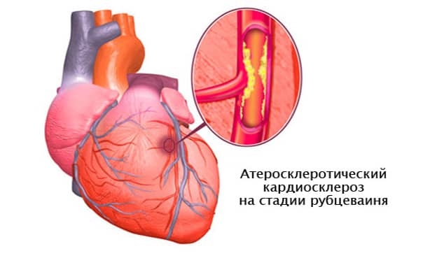 Атеросклеротический кардиосклероз 