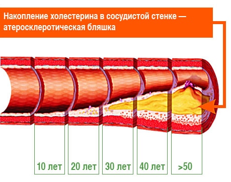 Атеросклероз патогенез профилактика лечение 