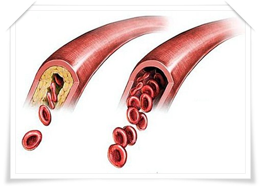 Атеросклероз — профилактика, лечение, питание 