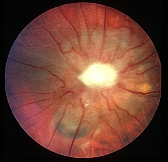 Атрофия нерва при глаукоме 