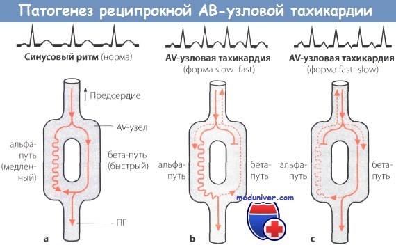 Ав реципрокная тахикардия пароксизмальная 