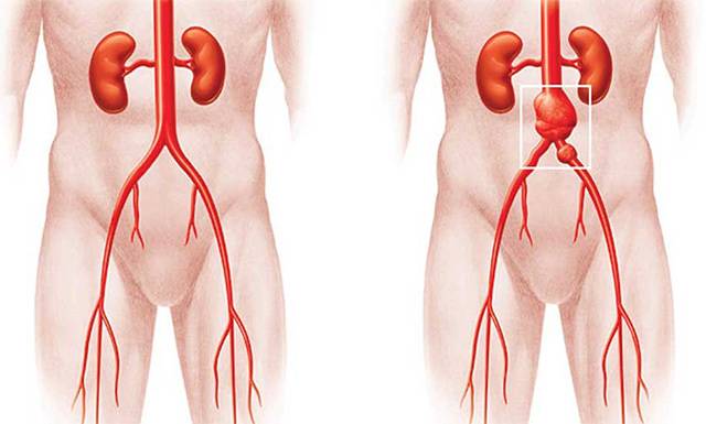 Чем опасен атеросклероз аорты брюшного отдела? 