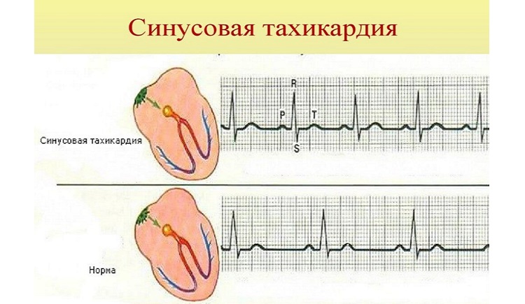 Чем различается тахикардия и аритмия или это одно и то же? 