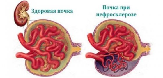 Что такое нефросклероз почек, как лечить 