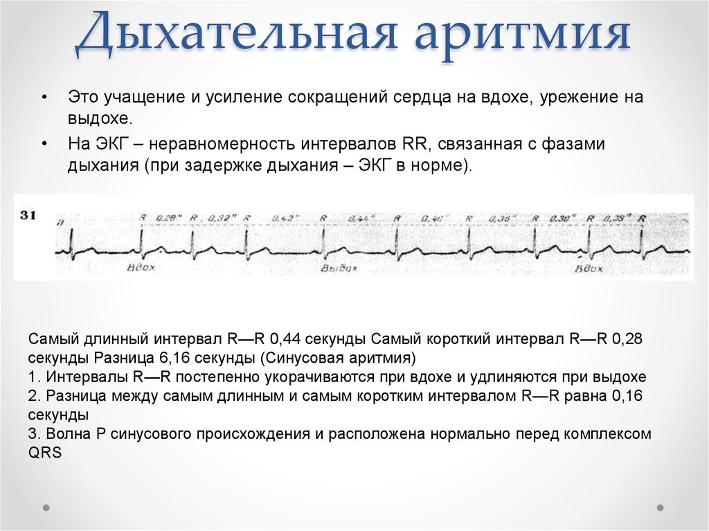 Дыхательная аритмия у взрослых 