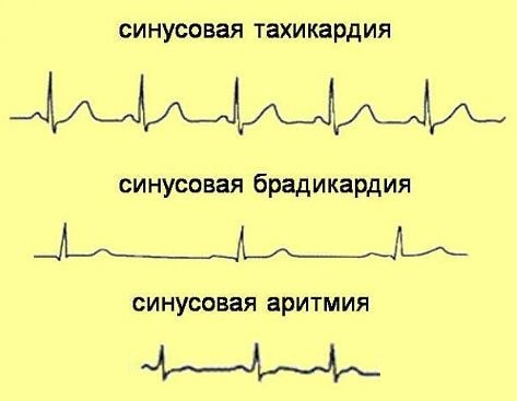 Экстрасистолия при климaкcе, признаки, лечение 