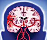 Геморрагический инсульт головного мозга 