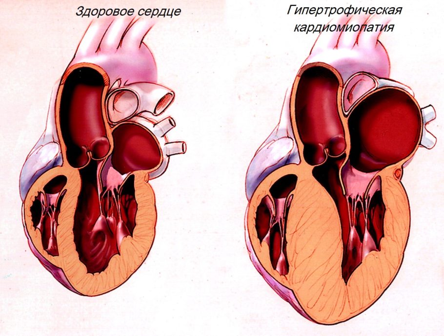 Гипертония сердца 