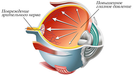 Глаукома причины симптомы лечение и профилактика диета 
