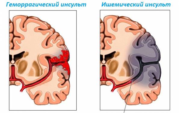 Ишемический инсульт головного мозга: признаки, первая помощь и лечение 