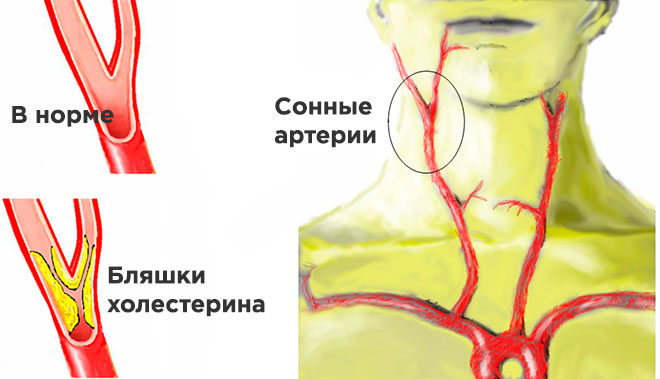 Как избавиться от холестериновых бляшек в сосудах шейного отдела 