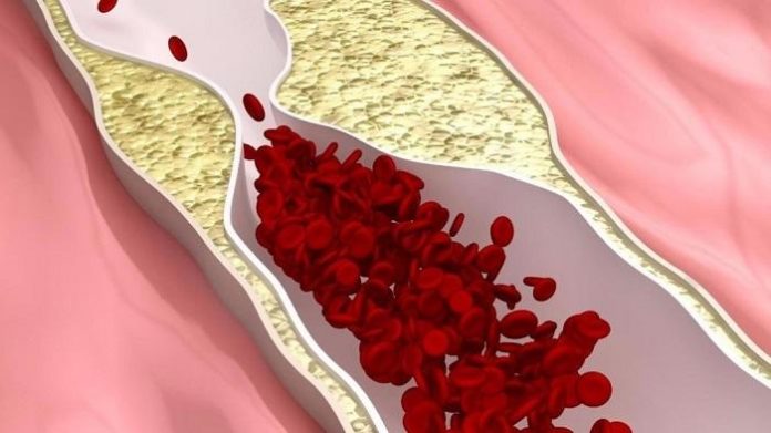 Как очистить сосуды при атеросклерозе: применение препаратов, народных средств, питание 