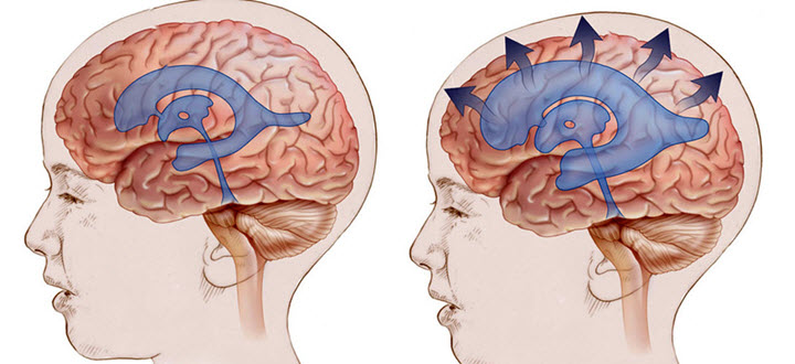 Лечение нормотензивной гидроцефалии у взрослых 
