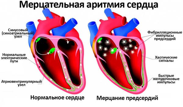 Лечение тахикардии сердца препаратами: антиаритмические, седативные и другие 