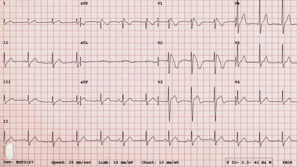 Мерцательная аритмия на ЭКГ: описание и признаки 