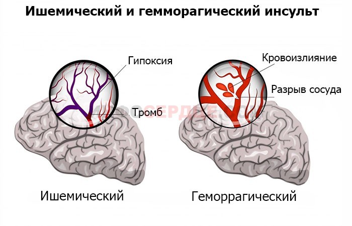 Микроинсульт у мужчин — чем отличается от инсульта, симптомы и первые признаки 