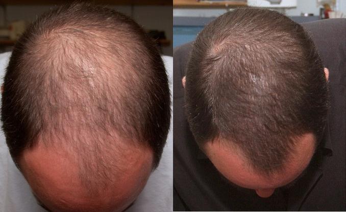 Миноксидил — революционное средство в борьбе с выпадением волос 