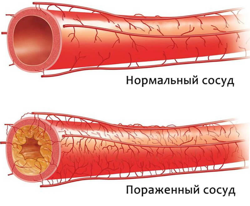 Основные причины атеросклероза коронарных артерий, диагностика и лечение 