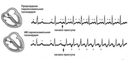 Признаки наджелудочковой тахикардии и ее эффективное лечение 