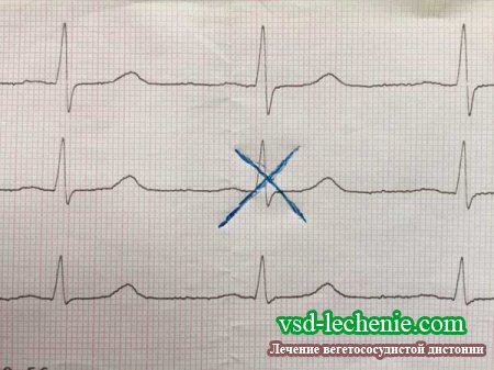 Симптомы и лечение экстрасистолии при ВСД 