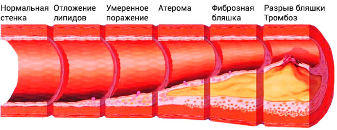 Стадии развития атеросклероза 