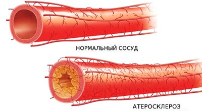 Атеросклероз — что это такое, причины, признаки, симптомы, осложнения, лечение и профилактика 