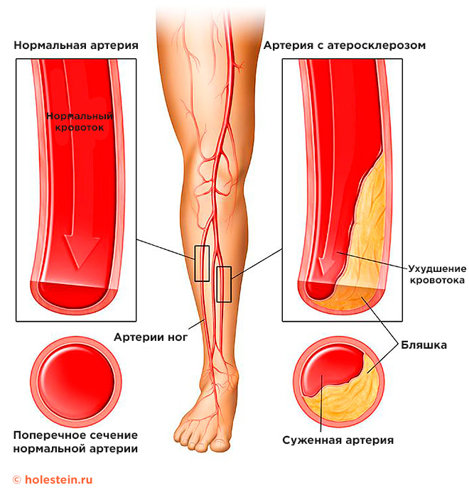 Атеросклероз сосудов нижних конечностей код по МКБ 10 