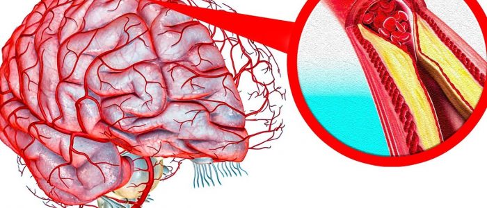 Бляшшки в сосудах головного мозга 