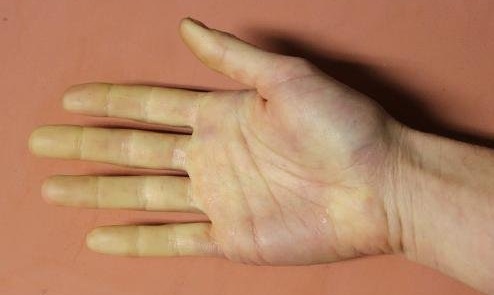 Болезни сосудов рук симптомы лечение 