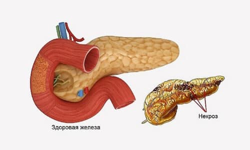 Эффективные методы лечения панкреонекроза 