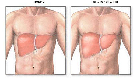 Гепатомегалия печени — что это, причины, симптомы, осложнения, лечение и диета 
