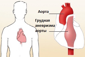 Аневризма грудной аорты 