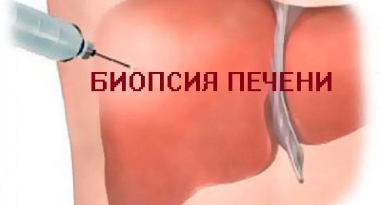 Биопсия печени: показания, способы и проведение, после процедуры 