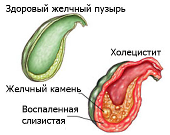 Что входит в лечебный диетический стол при холецистите и панкреатите? 