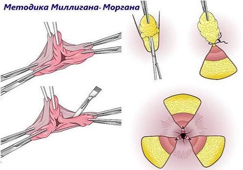 Диета после операции на геморрой 